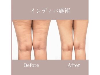 カノン(Kanon.)/インディバボディ