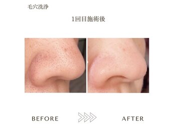 サロンエイトミー 西船橋店(salon 83)/毛穴ケア/before→after 1回施術