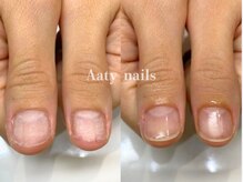 アーティネイルズ(Aaty Nails)/【深爪矯正】ハンド