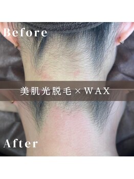 エピナ 横浜店(Epina)/うなじ脱毛/ブライダル脱毛