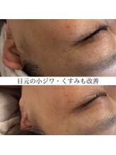 リフィール(Re:feel)/乾燥小ジワには保湿！保湿！