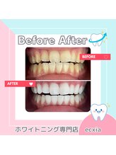 エクシアホワイトニング 札幌中島公園店/BeforeAfter［ホワイトニング］ 