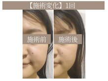 ドクターボディ 恵比寿店(Dr.Body)/【エラ張り/食いしばり 20代】