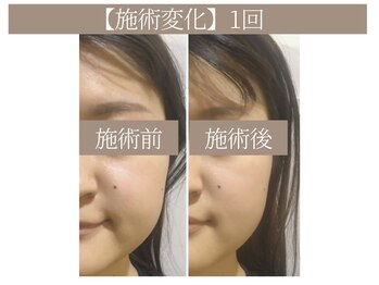 ドクターボディ 恵比寿店(Dr.Body)/【エラ張り/食いしばり 20代】