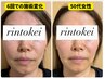 【50代からはこれ！】引き上がり止める！形状記憶美容鍼プログラム初回体験