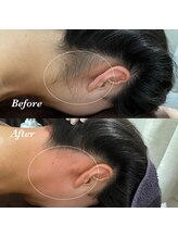 エレナビューティー(Elena Beauty)/うなじ脱毛