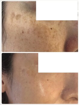 オアジスパ(Oasi Spa)/グリーンピール5Days1回