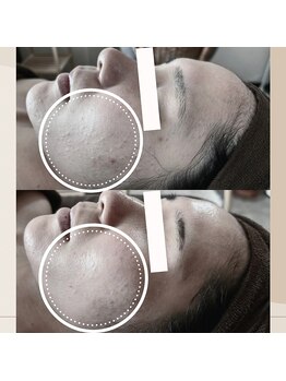 アノネ(Anone.)/剥離なしハーブピーリング