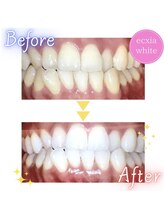 エクシアホワイト 新宿御苑店(ecxia white)/ホワイトニングビフォーアフター