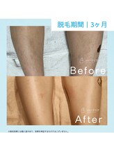 メンズクリア ゆめタウン筑紫野店/【メンズクリア】お客様の施術例