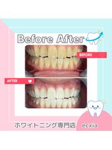 エクシアホワイトニング 札幌中島公園店/BeforeAfter［ホワイトニング］ 