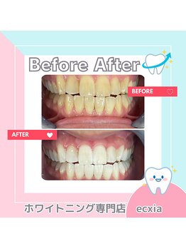 エクシアホワイトニング 札幌中島公園店/BeforeAfter［ホワイトニング］ 