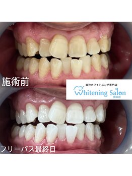 ホワイトニングサロン 熊本店/今からホワイトニング