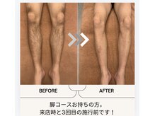 ユメバンチ(yumebanchi)/men's脚コース施術例です。