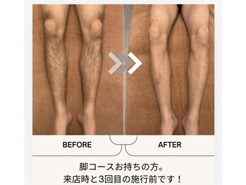 ユメバンチ(yumebanchi)/men's脚コース施術例です。