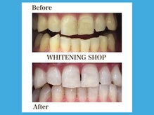 ホワイトニングショップ 福岡春日店/歯のキレイを追求！