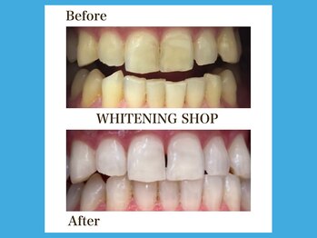 ホワイトニングショップ 福岡春日店/歯のキレイを追求！