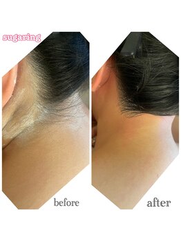 メンスエトマヌス(Mens et Manus)/うなじシュガーリング脱毛