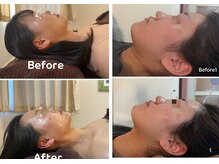 ニコリ 大宮(NICORI)/【小顔リフト】