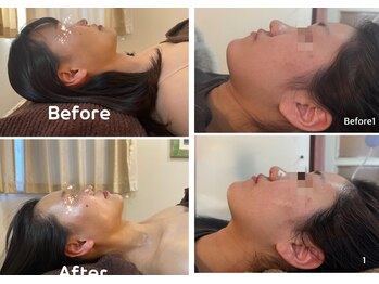 ニコリ 大宮(NICORI)/【小顔リフト】