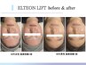 【モニター募集】エルテオンリフト《頬・顎下》通常5回¥132000→5回50000