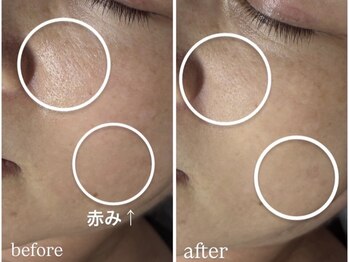 アンリミット 鹿児島天文館店(Une limit)/毛穴レス！