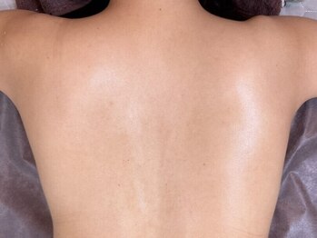 レイビューティサロン(Lei beauty salon)の写真/【ブライダル前の美肌準備へ】大人気のREVIハーブピーリングで透明感溢れる輝く美白背中に☆