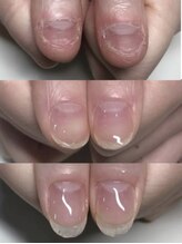 ティアラネイル 宇都宮/深爪矯正