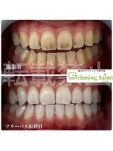ホワイトニングサロン 広島店&nbsp;通い放題☆ 