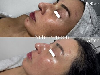 ナチュールムーン(Nature moon.)/ハーブピーリング
