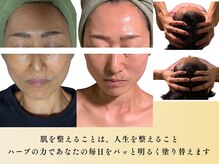 スカイ(sky)/エクソソームハーブピーリング