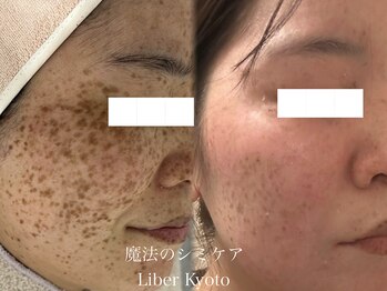 エステティック リベル キョウト 京都駅前店(Esthetic Liber Kyoto)/魔法のシミケア