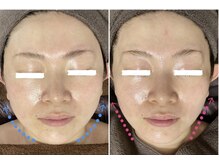 チャルメの雰囲気（筋膜リペア(深層筋肉ほぐし＆トレーニング)形状記憶でリフトUP↑）