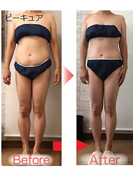 ピーキュア/2回ビフォーアフター