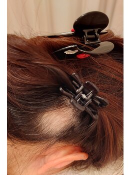 はる鍼灸整骨院/髪のお悩み◇もう一度↓10回目