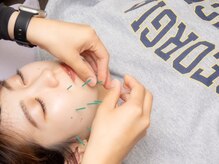 たきもと鍼灸整骨院/美容鍼