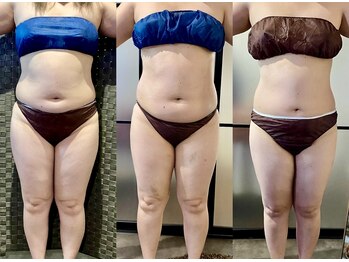 カルナ(CARNA)/【痩身】セルライトゼロ2