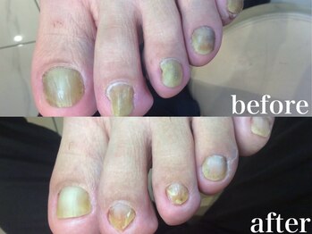 ドクターネイル爪革命 札幌本店/症例紹介3 肥厚爪