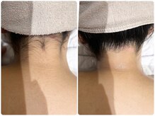 ワイスリー(Y3)/うなじ、背中上脱毛