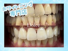ドルチェ(Dolce)/ビフォーアフター