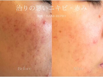 エメ(Aimee)/HAAB REPRO