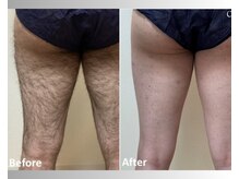 アップパイン(UPPINE)/足脱毛/大国町/8,800円