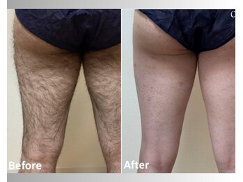 アップパイン(UPPINE)/足脱毛/大国町/8,800円