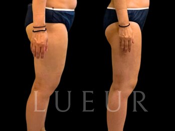 リュール北千住(LUEUR)/足施術事例