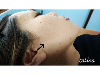 ブラジリアンワックスサロンカリーナ(Carina)/フェイスワックス