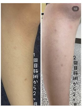 タグ シー(#She)/中学生ひざ下beforeafter
