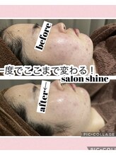 サロンシャイン(Salon Shine)/REVIハーブで赤ら顔もスッキリ