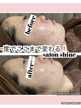 サロンシャイン(Salon Shine)/REVIハーブで赤ら顔もスッキリ