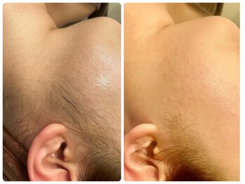 ブリリアント(Brilliant)/ブライダルシェービング