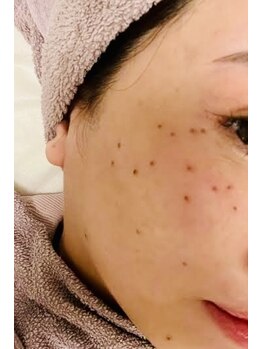 ファミリーセルフサロン 輪(Wa)/シミケアお試し